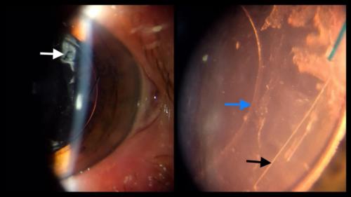 Residual lens material after cataract surgery complicated by posterior capsule rupture